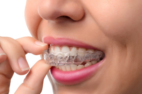 Aligneurs invisibles