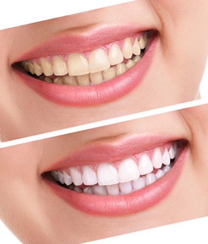 Blanchiment dentaire