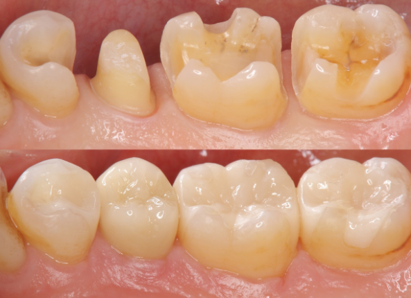 Traitement des caries