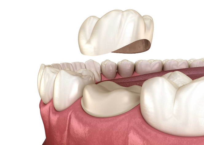 Couronne dentaire