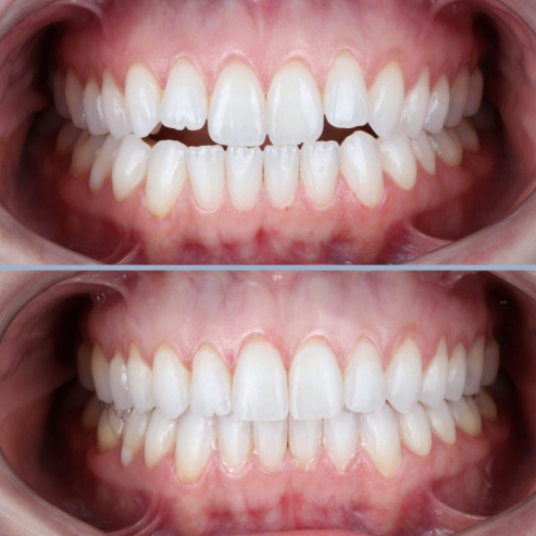 Résultat d'alignement