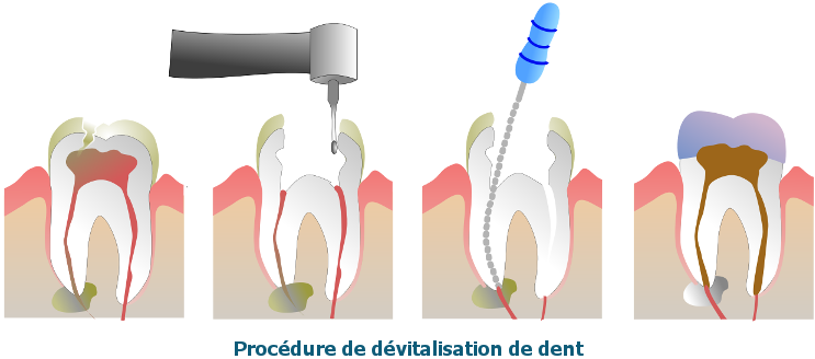Dévitalisation dentaire