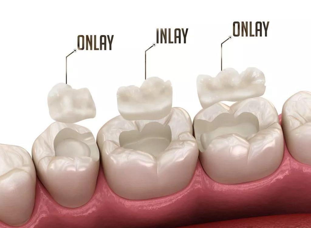 Onlay dentaire